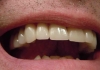 Düşen Dişlerin Yerine Doğal Olarak Yenisini Çıkaran İlacın İlk Testi Başarılı Oldu!