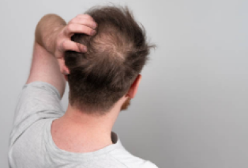 Erkeklerde Aşırı Saç Dökülmesi Nedenleri Ve Tedavisi Nedir?