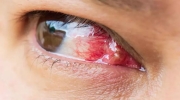 Pterjium Hastalığı Nedir? Tedavisi Nasıl Yapılır? Gözün Doğal Görünümünü Bozan Hastalık! 